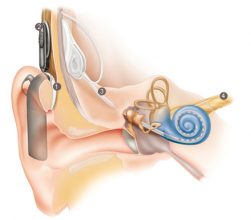 cochlear implants