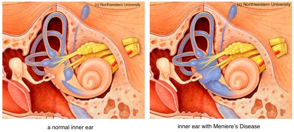 Meniere's Disease Learn About Symptoms + Treatments