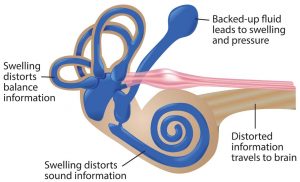 menieres disease causes