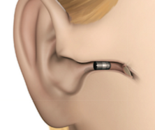 Invisible Hearing Aids Sitting In The Ear