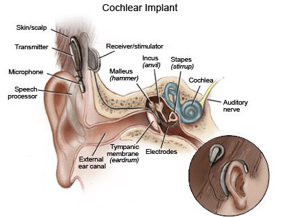 The Bionic Ear Or Cochlear Implant