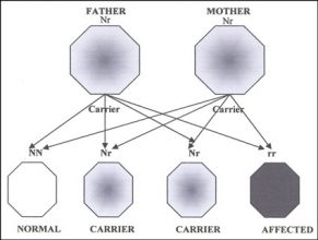 usher syndrome chromosome affected usher syndrome chromosome affected