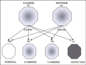 Usher Syndrome Hereditary