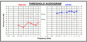 audiogram