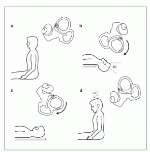 bppv manouvers