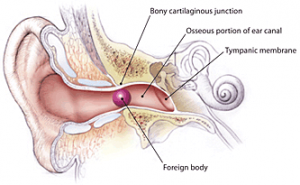 conductive hearing loss surgery