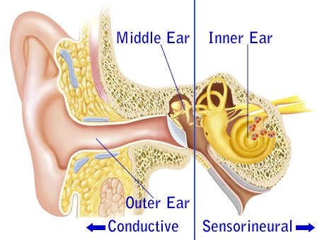 conductive hearing loss