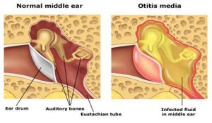 normal v otitis media