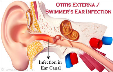 Otitis Externa