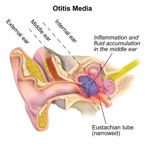 otitis media