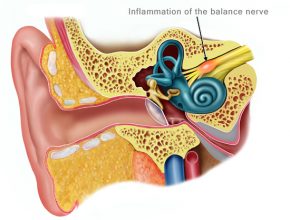 vestibular neuritis