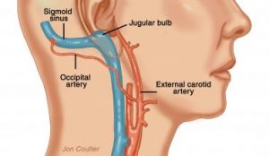 what is Pulsatile Tinnitus