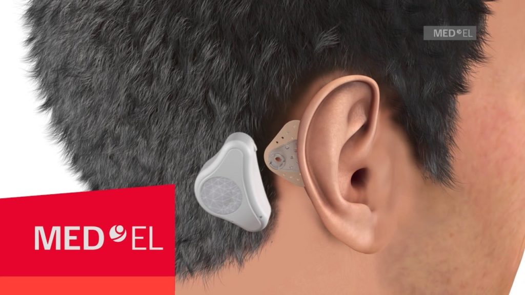 bone conduction hearing aid